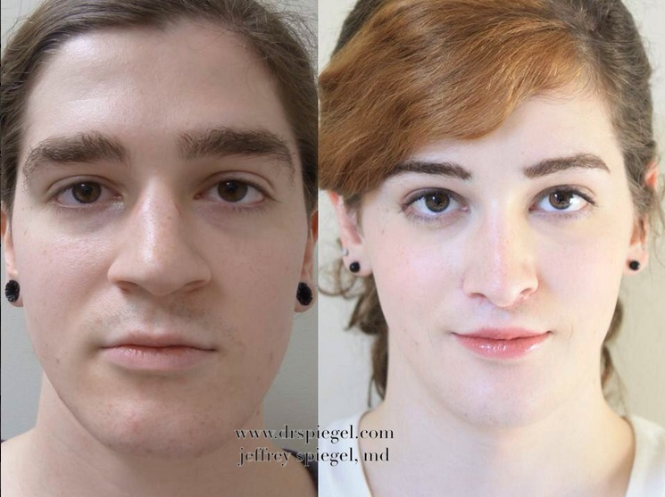 feminization Transsexual sugery facial