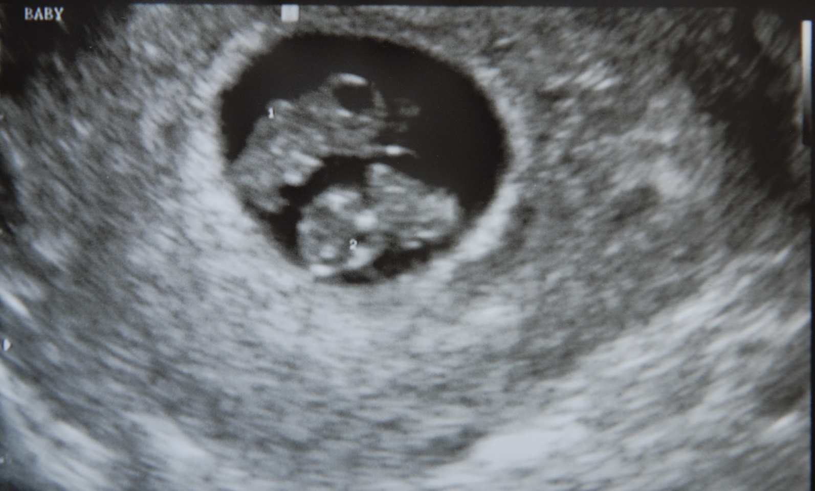 Многоплодная беременность на УЗИ 7 недель